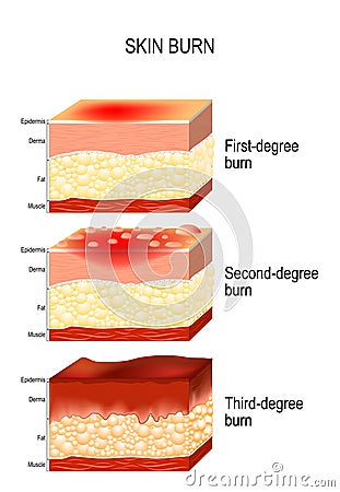 Skin burn. Three degrees of burns. Vector Illustration