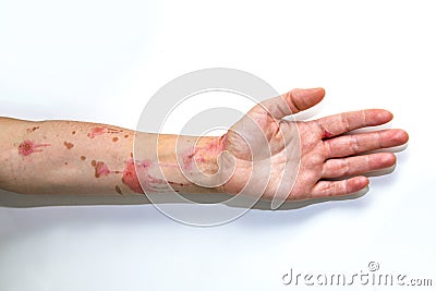 Skin burns on human arm Stock Photo