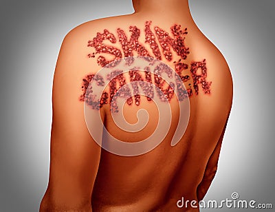 Skin Cancer Melanoma Stock Photo