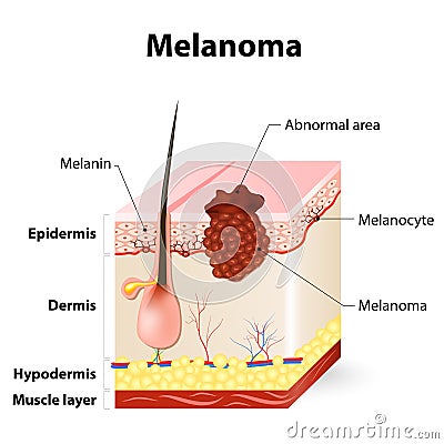 Skin cancer. Melanoma Vector Illustration