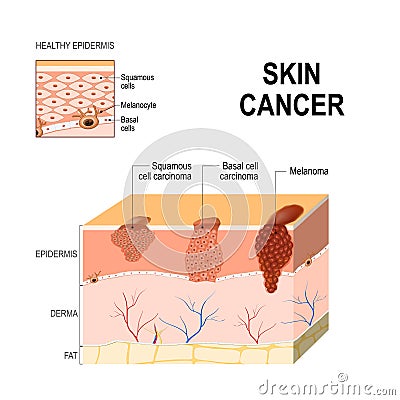 Skin cancer. Squamous cell carcinoma, basal-cell cancer and Melanoma. Vector Illustration