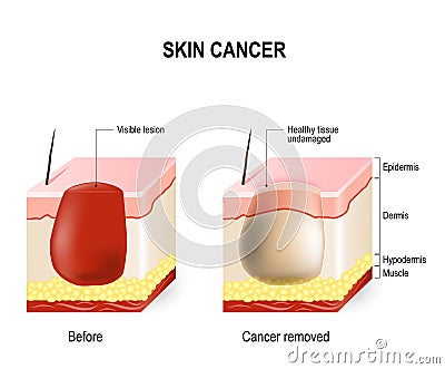 Skin cancer Vector Illustration