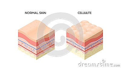 skin with cellulite and normal skin cross-section of human skin layers structure skincare medical concept flat Vector Illustration