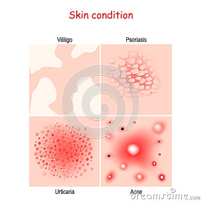 Skin condition and diseases. Close-up of Acne, Urticaria, Psoriasis, Vitiligo Vector Illustration