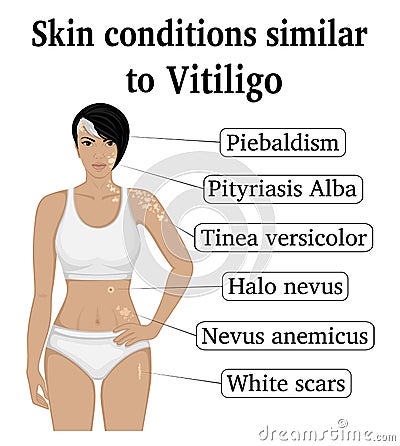 Skin conditions similar to Vitiligo Vector Illustration