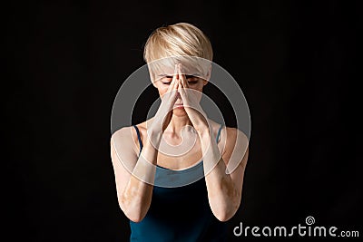 Skin defects. Woman with vitiligo is praying Stock Photo