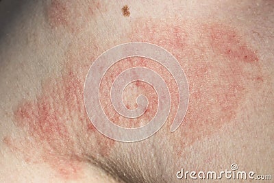 Skin dermatitis Stock Photo