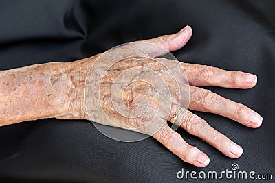 Skin desease Stock Photo