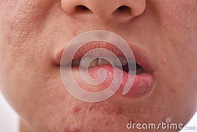 Skin disease problem , Dry and chapped lip from lip biting, Acne scar and pimples with large pore. Stock Photo