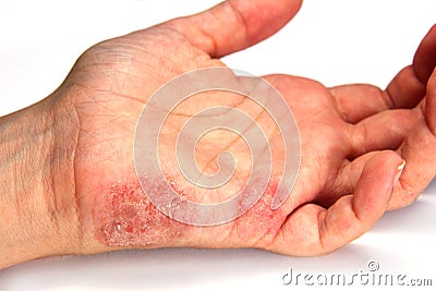 Skin Disease Stock Photo