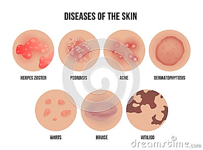 Skin disease, types of dermatology problems with names Vector Illustration
