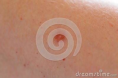 Skin diseases. Problem of skin lesions. Health concept Stock Photo