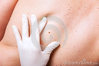 Skin examination of moles Stock Photo