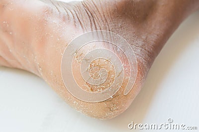 Skin heel crack and skin peeling. Stock Photo