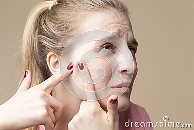 Skin Issues. Portrait of Young Emotional Caucasian Blond Woman With Skin Problems Squeezing Pustules By Fingers Against Beige Stock Photo