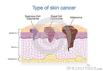 Skin layer have 3 Type of Cancer in one. Vector Illustration