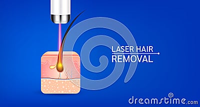 Skin layers anatomy with hairs and yellow laser light hair removal. Unwanted out make skin smooth. Banners are used for beauty adv Vector Illustration