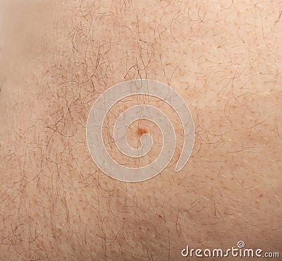 Skin mole closeup. Macro photo of blemish similar to melanoma Stock Photo