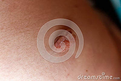 Skin nodule on a buttock Stock Photo