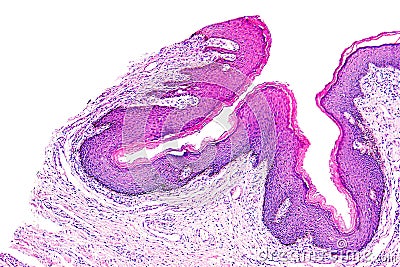 Skin papilloma of a human Stock Photo