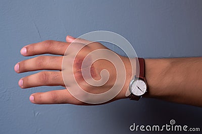 skin patch test on a wrist with a watch nearby Stock Photo