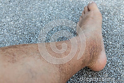 Skin pigmentation on neglected leg of matured male Asian Stock Photo