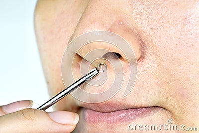 Skin problem with acne diseases, Close up woman face squeezing whitehead pimples on nose with acne removal tool Stock Photo