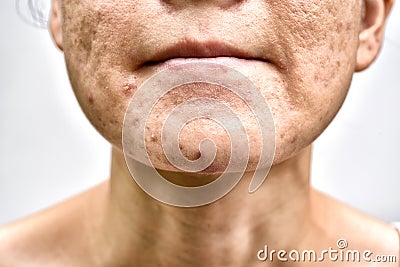 Skin problem with acne diseases, Close up woman face with whitehead pimples on chin, Menstruation breakout. Stock Photo