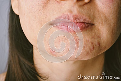 Skin problem with acne diseases, Close up woman face with whitehead pimples on chin Stock Photo