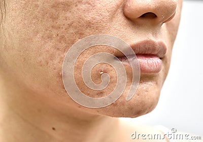 Skin problem with acne diseases, Close up woman face with whitehead pimples, Menstruation breakout, Scar and oily greasy face. Stock Photo