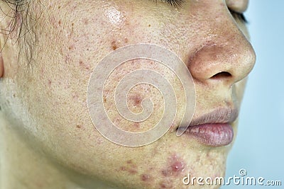 Skin problem with acne diseases, Close up woman face with whitehead pimples, Menstruation breakout. Stock Photo