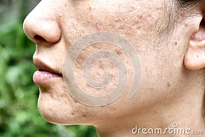 Skin problem with acne diseases, Close up woman face with whitehead pimples, Menstruation breakout. Stock Photo