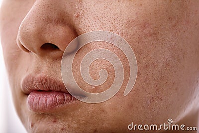 Skin problem with acne diseases, Close up woman face with whitehead pimples on mouth. Stock Photo