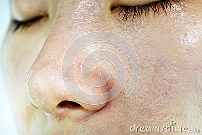 Skin problem with acne diseases, Close up woman wrinkle face with whitehead pimples on nose Stock Photo