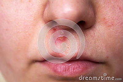 Skin problem Stock Photo