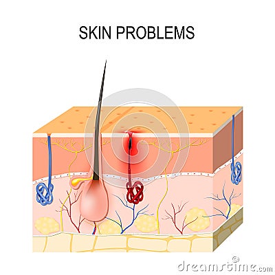 Skin problems. Clogged pores Vector Illustration