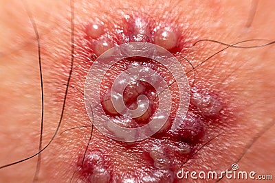 Skin rash and blisters on body. Shingles on men herpes zoster Stock Photo