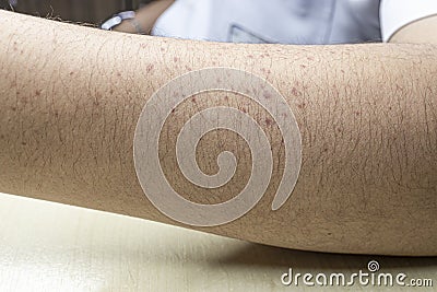 Skin rash in a patient diagnosed with chikungunya disease Stock Photo