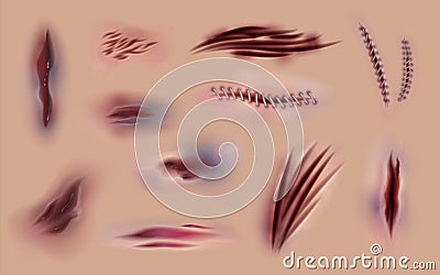 Skin scars and wounds. Surgery stitches and horror wounds on skin, different injuries and bruises. Vector body wound and Vector Illustration