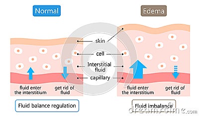 Diagram of edema and normal skin. swelling is caused by excess fluid within the tissues of the body. Before after illustration. Vector Illustration