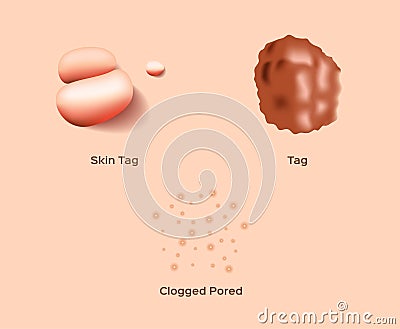 Skin tag and clogged pored Vector Illustration