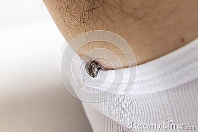 Skin tag mole darkened, scorched and dried up Stock Photo