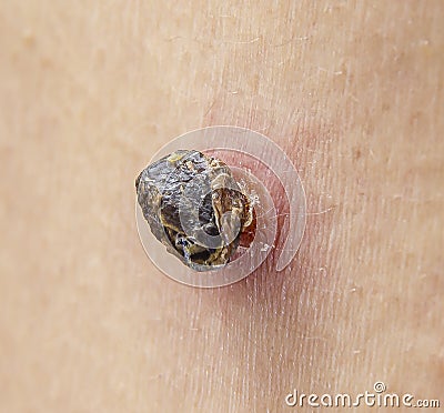 Skin tag mole darkened, scorched and dried up Stock Photo