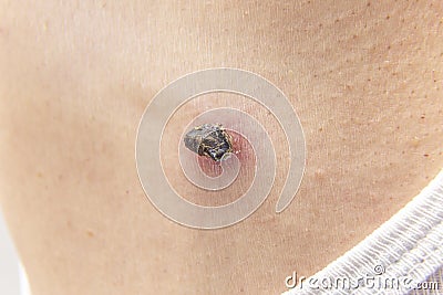 Skin tag mole darkened, scorched and dried up Stock Photo