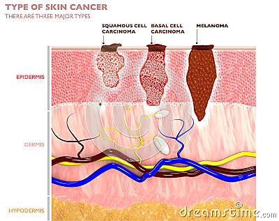 Skin tumors, moles and spots, 3d section of the skin layer Stock Photo