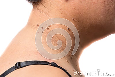 Skin of a woman with moles Stock Photo