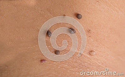 Skin of a woman with moles Stock Photo