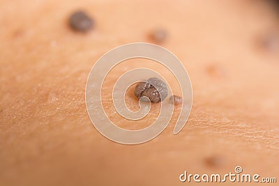 Skin of a woman with moles Stock Photo