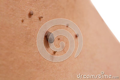 Skin of a woman with moles Stock Photo