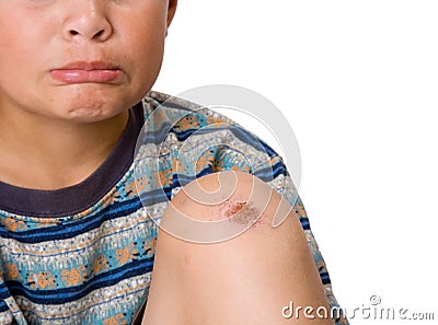 Skinned knee--ouch! Stock Photo